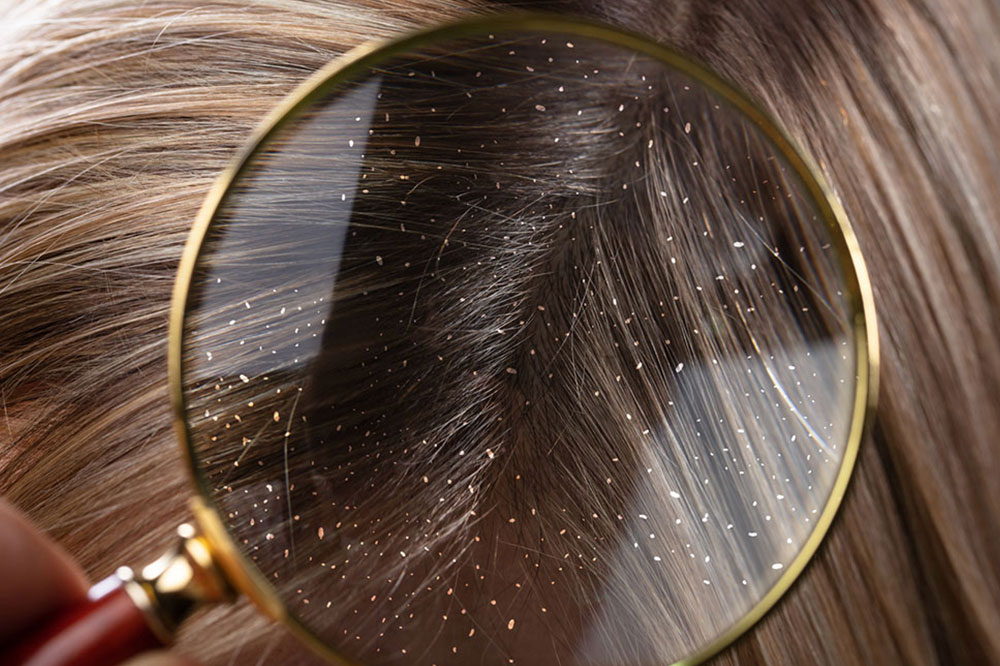 7 Effective Natural Solutions to Control Dandruff and Flaky Scalp