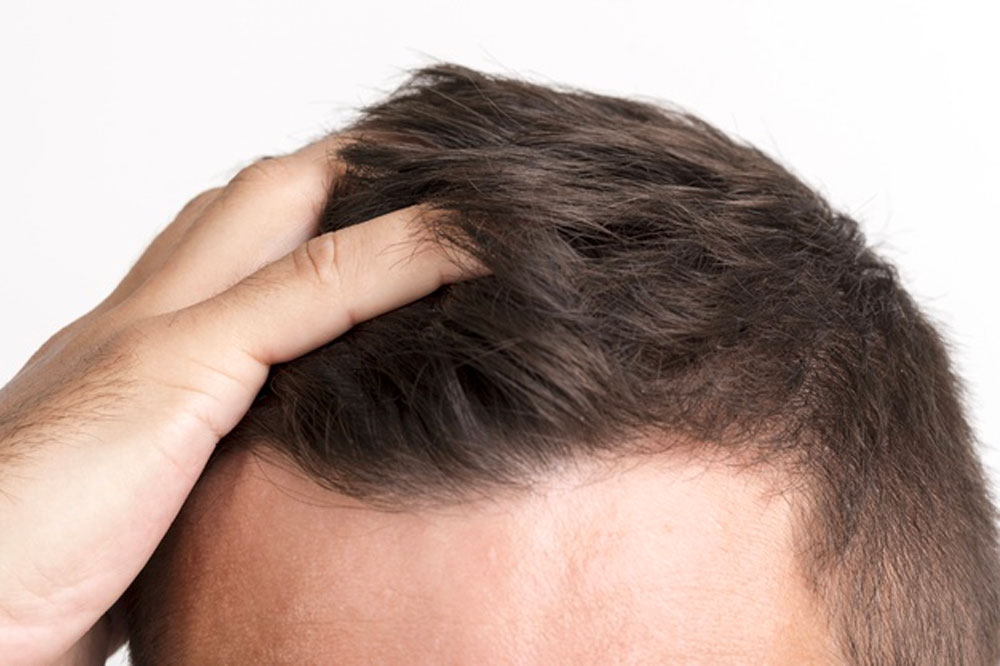 Common Symptoms and Treatments of Hair Loss