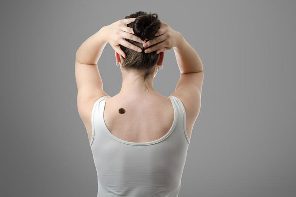 The Common Types of Skin Cancer