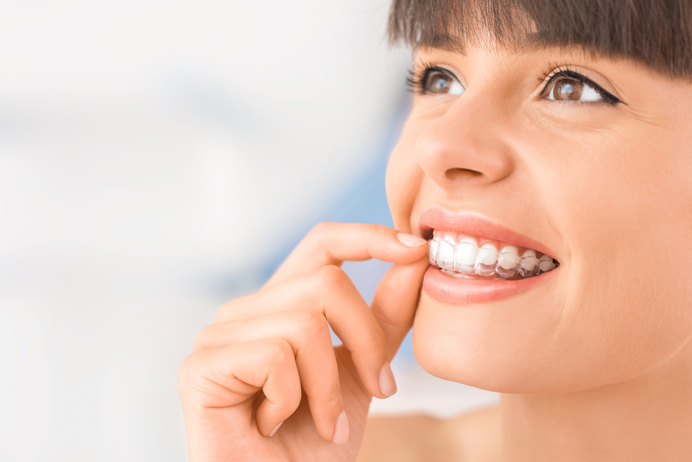 6 Reasons To Choose Clear Aligners For Straight Teeth